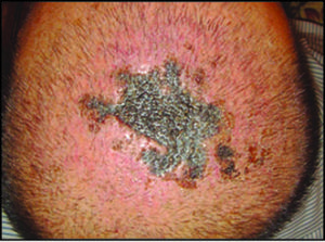 عوارض جانبی کاشت مو که کمتر اتفاق می افتد