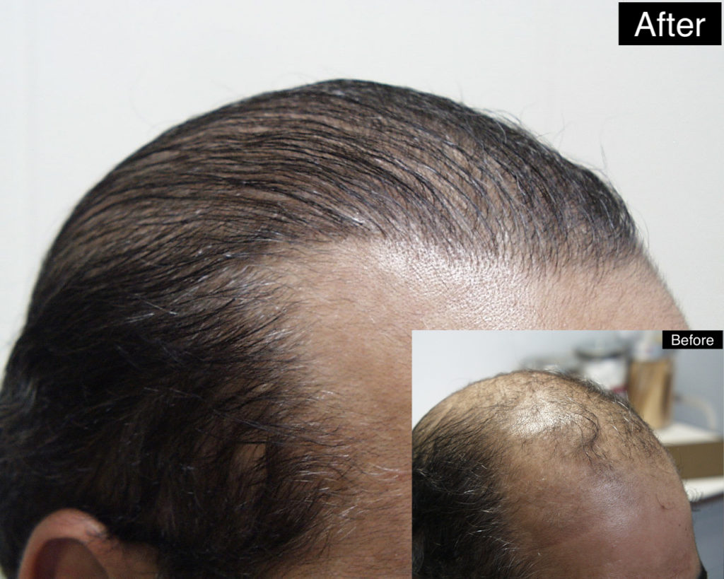 چطوری برای کاشت موی طبیعی آماده بشویم | انتخاب بهترین جراح کاشت موی طبیعی