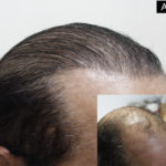 چطوری برای کاشت موی طبیعی آماده بشویم | انتخاب بهترین جراح کاشت موی طبیعی