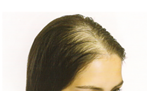 علل ریزش مو- کاشت مو
