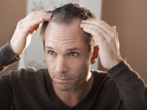 علت ریزش مو در مردان 