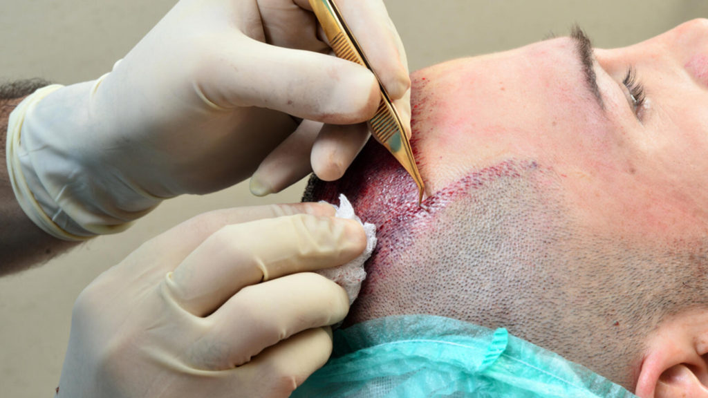 مشکلات کاشت مو | نکاتی که قبل از کاشت مو باید بدانید