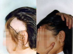 تجربه کاشت مو برای یکی از زنان