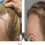 کاشت مو فقط برای مردان نیست | کاشت مو برای زنان | طاسی الگوی زنانه