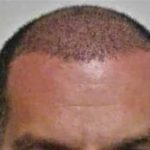 کاشت مو درمان قطعی ریزش مو