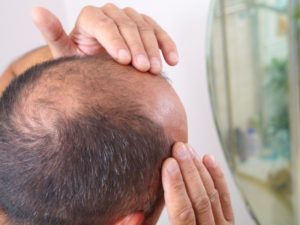 مراقبت از پوست سر بعد از کاشت مو | نحوه خوابیدن پس از کاشت مو 