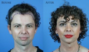 کاشت مو برای تبدیل فرم موی مردانه به زنانه 