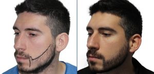 دارو برای تبدیل فرم موی زنانه به مردانه 