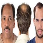 طاسی الگوی مردانه | علل ، علائم و دارو | کاشت مو درمان دائمی طاسی