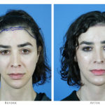 کاشت مو برای افراد ترنسجندر | دارو برای تبدیل فرم موی زنانه به مردانه