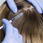 مزوتراپی مو